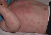 Fig 2. Urticaria