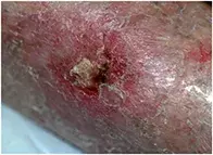 Fig 1. Nonhealing lesion.