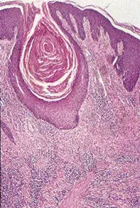 Fig 2. Scalp biopsy