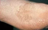 Fig 1. Tan patch Fig 1. Tan patch