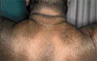 Fig 1. Thickened skin Fig 1. Thickened skin