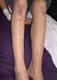 Fig. Leg rash