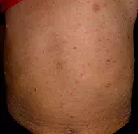 Fig 1. Rash